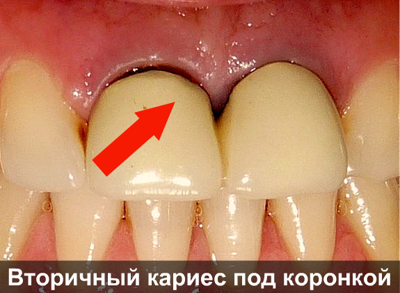 Зубы под коронкой могут испортиться Зубы под коронкой могут испортиться