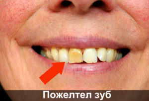 Пожелтел зуб фото