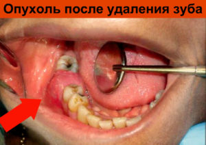 Отек после удаления зуба