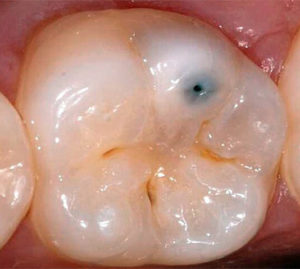 легкая боль в зубе фото