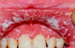 причины острого герпетического стоматита фото