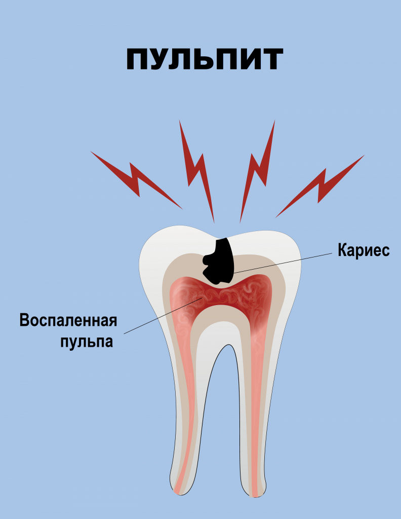 Пульпит зуба картинки