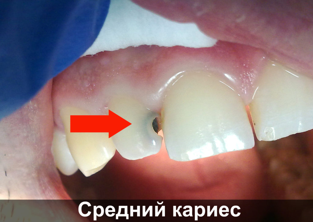 Зуб стал чувствительным и болит