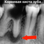 Корневая киста зуба фото