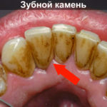 Зубной камень фото