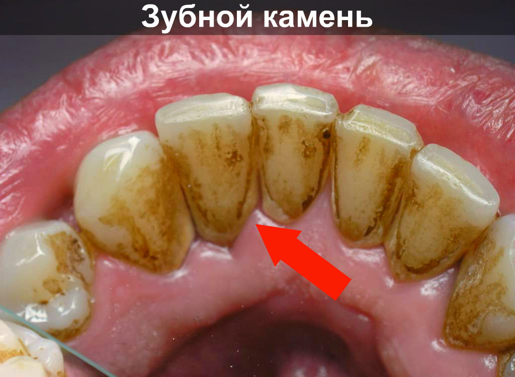 Зубной камень на нижних зубах