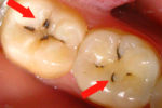 Темная точка на зубе: причины и устранение