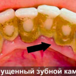 Запущенный зубной камень фото