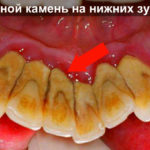Зубной камень на нижних зубах фото