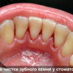 Зубы после чистки у стоматолога