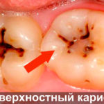 Поверхностный кариес фото