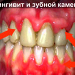 Гингивит фото