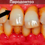 Пародонтоз фото