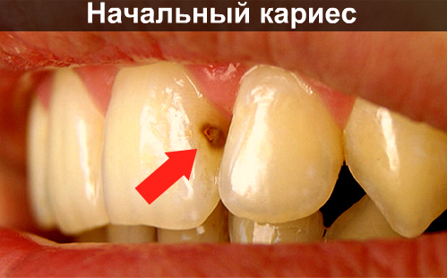 Как вылечить черные точки на зубах