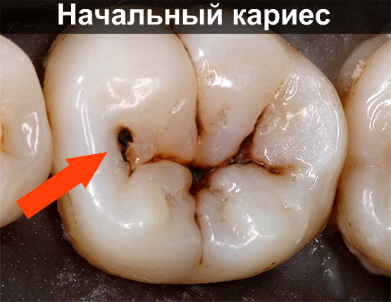 Как вылечить черные точки на зубах thumbnail