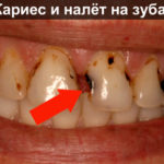 Кариес на зубах