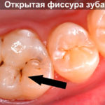 Открытая фиссура зуба фото