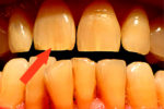 Полосы на зубах: причины появления, методы лечения, фото