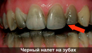 Черный налет на зубе фото