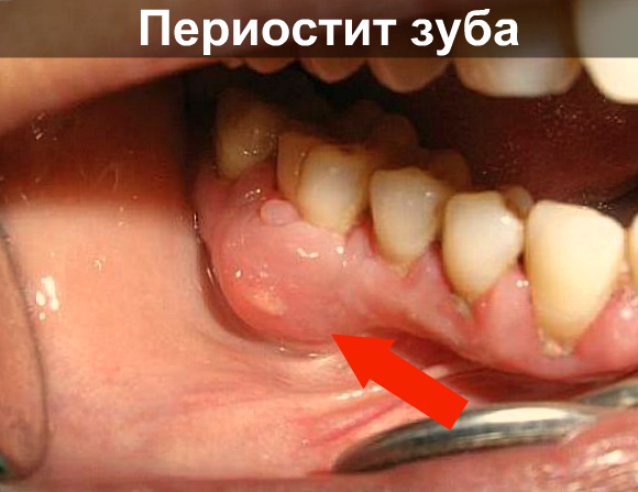 Воспаление зуба от горячего