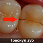 Треснул зуб фото