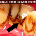 Коричневый налет на зубах курильщика