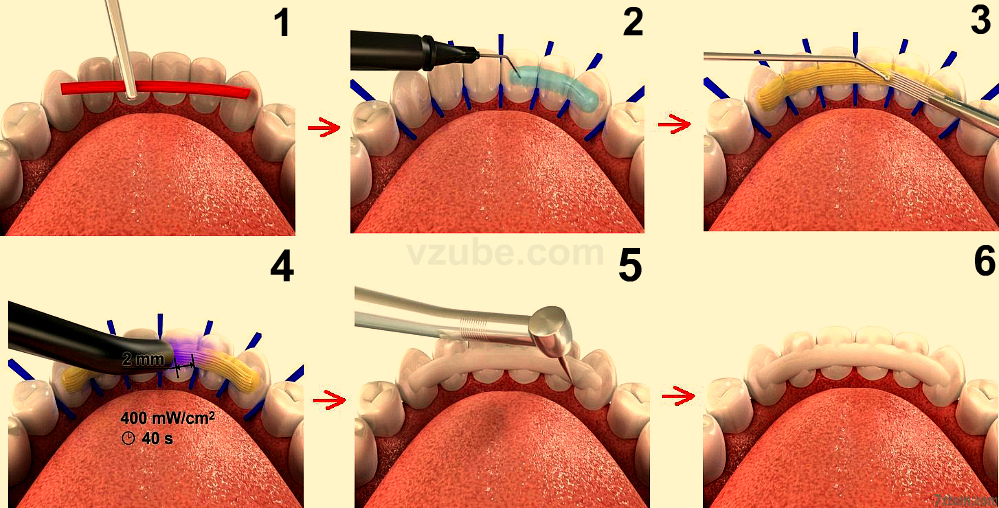Этапы шинирования зуба 
