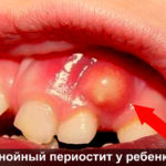 Гнойный периостит у ребенка