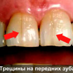 Трещины на передних зубах фото