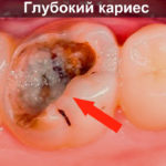 Глубокий кариес фото