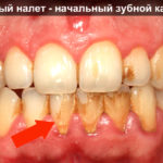 Зубной налет фото