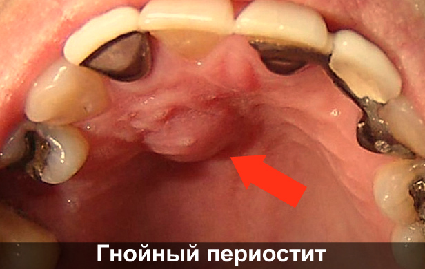Почему зуб может болеть от горячего