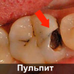 Пульпит жевательного зуба фото