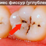 Фиссурный кариес фото