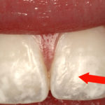 Царапины на зубе фото
