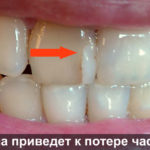 Трещина приведет к потере части зуба