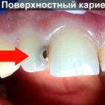Поверхностный кариес фото