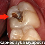 Кариес зуба мудрости фото