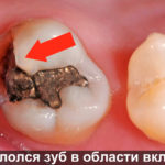 Откололся зуб в области вкладки