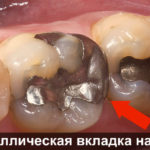 Кладка на зубе фото