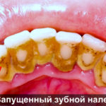 Запущенный зубной налет фото