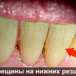 Трещины на нижних резцах