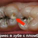 Кариес в зубе с пломбой