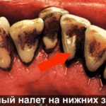 Черный налет на зубах фото