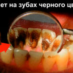 Черный налет на зубе