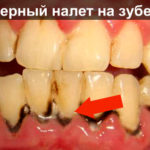 Черный налет на зубах фото