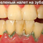 Зеленый налет на зубах фото