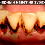 Черный налет на зубах фото