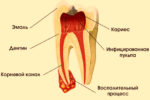 В зубе гной: причины появления и методы лечения