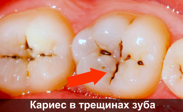 Развитие начального кариеса в трещинах зуба